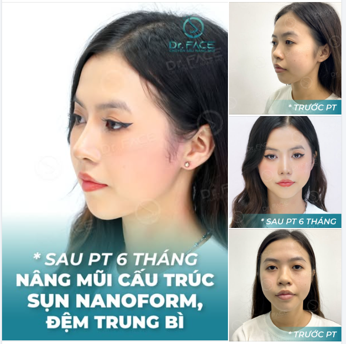 TIKTOKER XINH ĐẸP không ngại “CÔNG KHAI” chuyện NÂNG MŨI