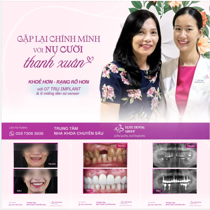 GẶP LẠI MÌNH TRONG NỤ CƯỜI THANH XUÂN SAU PHỤC HỒI RĂNG VỚI 7 TRỤ IMPLANT VÀ 6 MIẾNG DÁN SỨ VENEER