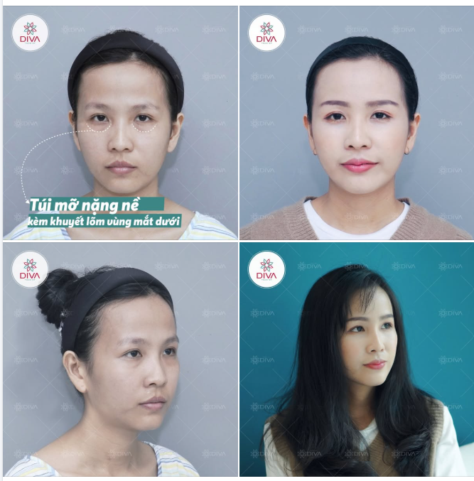 BỌNG MẮT NẶNG NỀ VÀ KHUYẾT LÕM MẮT DƯỚI – "THỦ PHẠM" KHIẾN BẠN GIÀ NUA, THIẾU SỨC SỐNG!