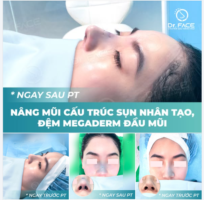 DÙNG MEGADERM ĐỆM ĐẦU MŨI ĐƯỢC KHÔNG