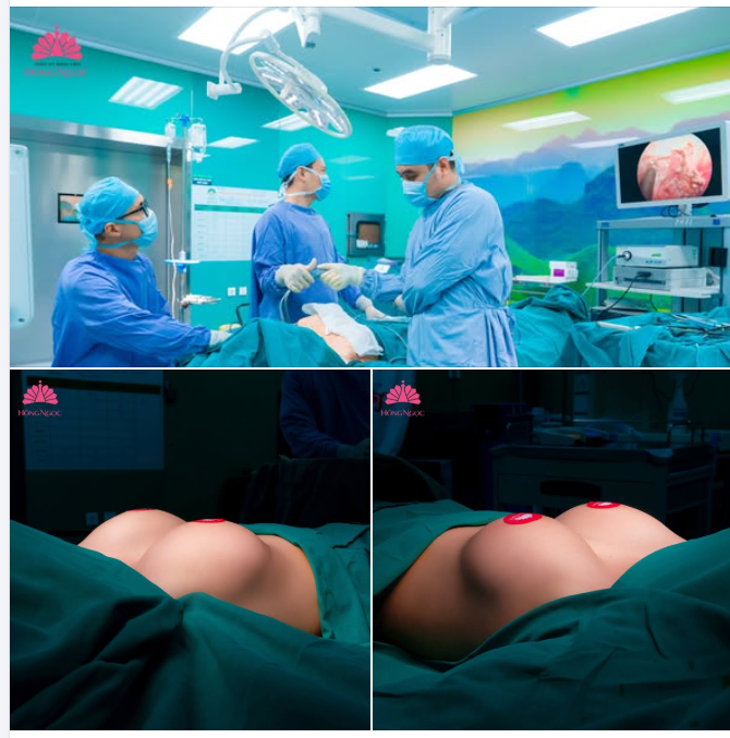 Nâng ngực nội soi: Giải pháp an toàn - Kiến tạo V1 căng tròn, hoàn hảo