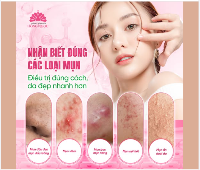 Nhận biết đúng các loại mụn: Điều trị đúng cách, da đẹp nhanh hơn