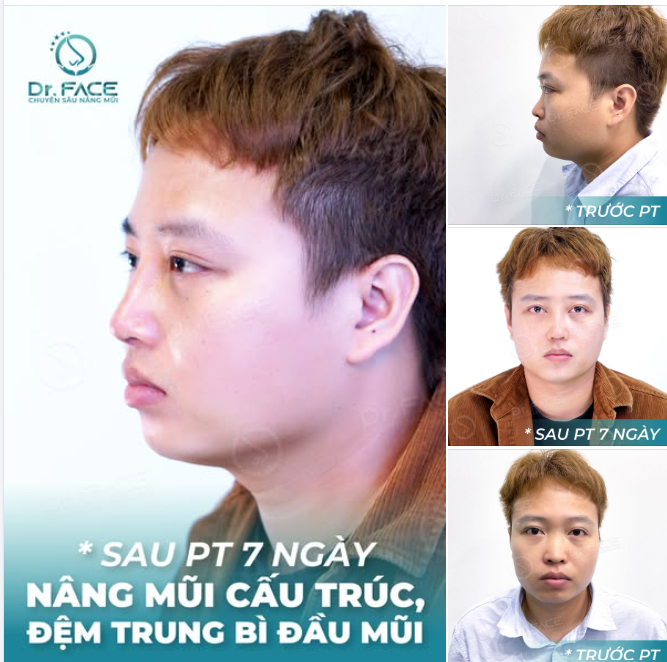 MỘT CA MŨI NAM GIỚI QUÁ MEN