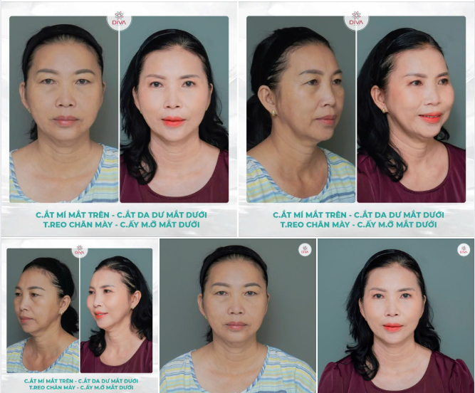 57 TUỔI - CẢI THIỆN THẦN THÁI, TRẺ LẠI TỪ ĐÔI MẮT