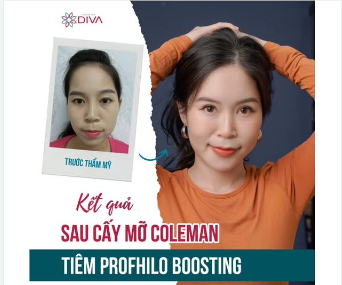 TRẺ TRUNG, ĐẦY SỨC SỐNG - KẾT QUẢ TỪ SỰ KẾT HỢP CỦA 2 PHƯƠNG PHÁP C.ẤY MỠ COLEMAN + T.IÊM PROFHILO