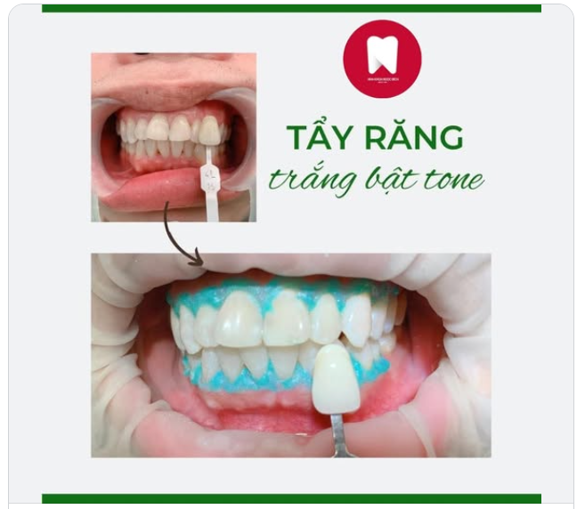 Bật tone với dịch vụ tẩy trắng răng tại Nha Khoa Ngọc Bích
