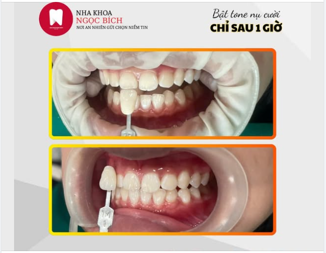TỰ TIN TỎA SÁNG VỚI NỤ CƯỜI TRẮNG SÁNG
