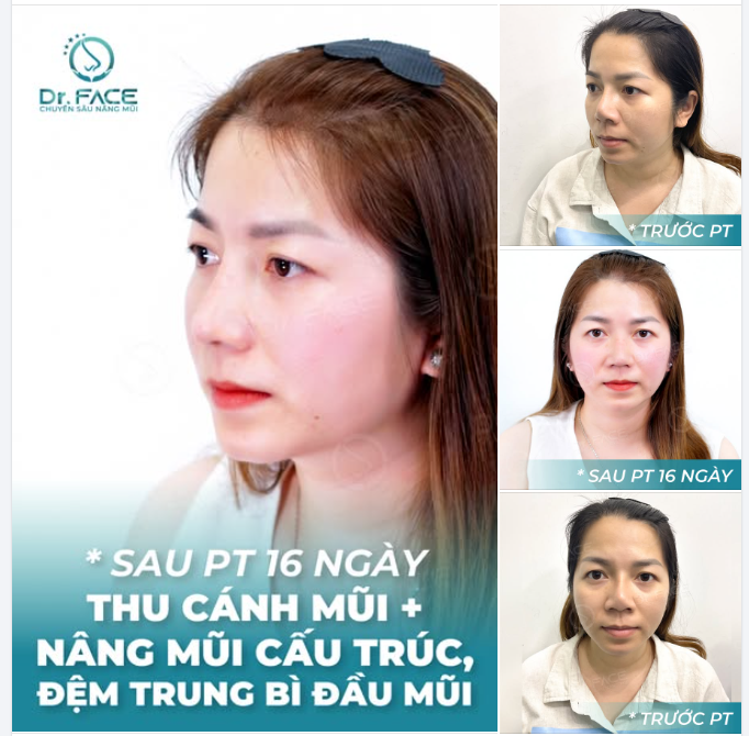“GIẢI CỨU” ĐẦU MŨI EM BS ƠI”