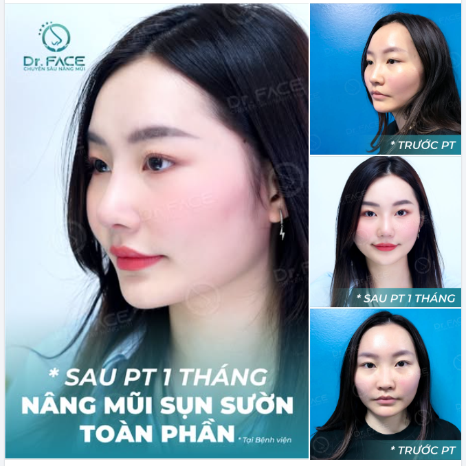 “Tân trang” chiếc mũi  “Chỉnh sửa” cuộc đời…