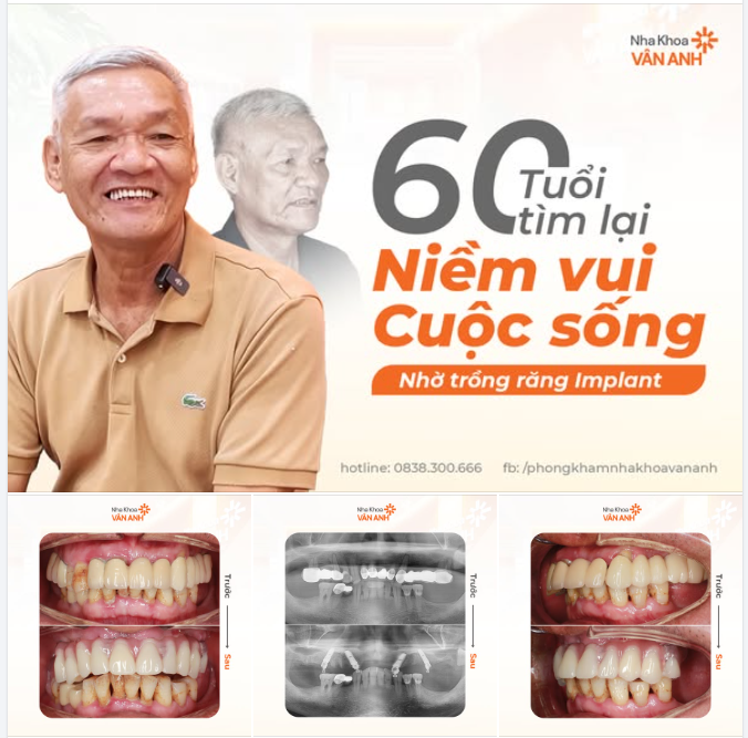 NHIỀU ĐÊM KHÔNG NGỦ NỔI, TRẰN TRỌC SUY NGHĨ RĂNG MIỆNG CHÁU Ạ...