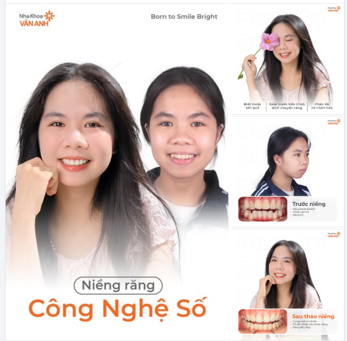 Niềng răng công nghệ số – Hành trình Hương Ly tìm lại nụ cười tự tin với trải nghiệm an toàn và an tâm