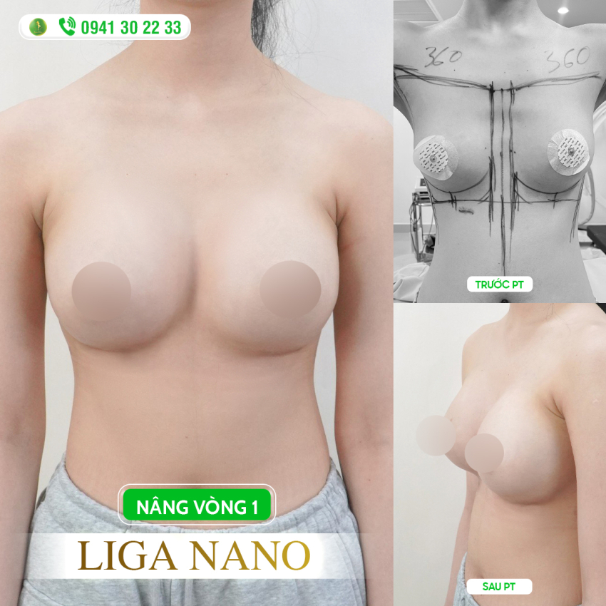 TRẢ LẠI VÒNG 1 TỶ LỆ VÀNG VỚI GIẢI PHÁP LIGA NANO