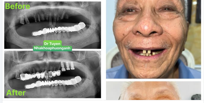Ai Là Người Phù Hợp Để Làm Implant Răng?