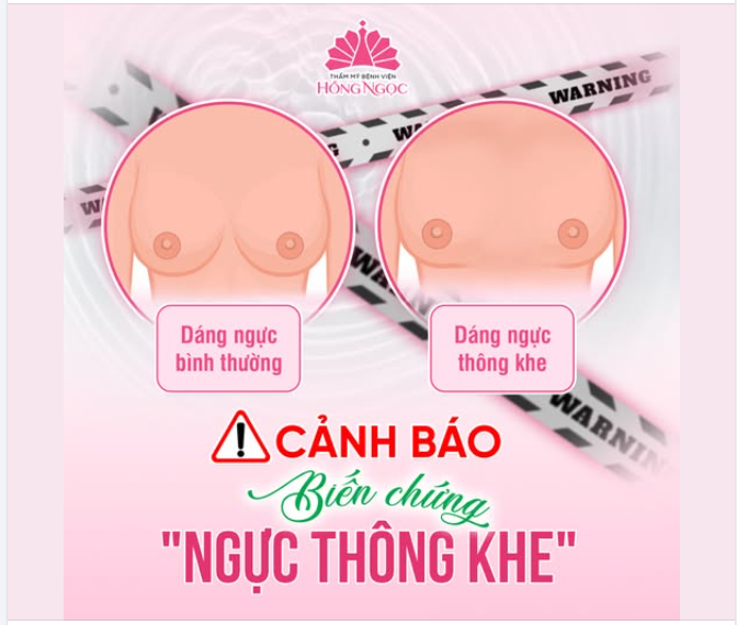 CẢNH BÁO BIẾN CHỨNG “NGỰC THÔNG KHE” SAU NÂNG NGỰC - ĐỪNG ĐỂ CÁI ĐẸP TRỞ THÀNH RỦI RO!