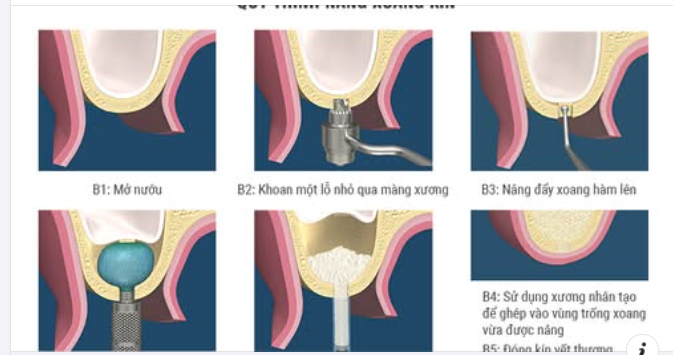NÂNG XOANG TRONG CẤY GHÉP IMPLANT