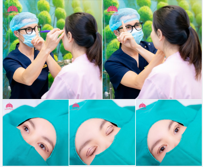 VÌ SAO ĐO VẼ NẾP MÍ TRƯỚC PHẪU THUẬT LẠI QUAN TRỌNG?