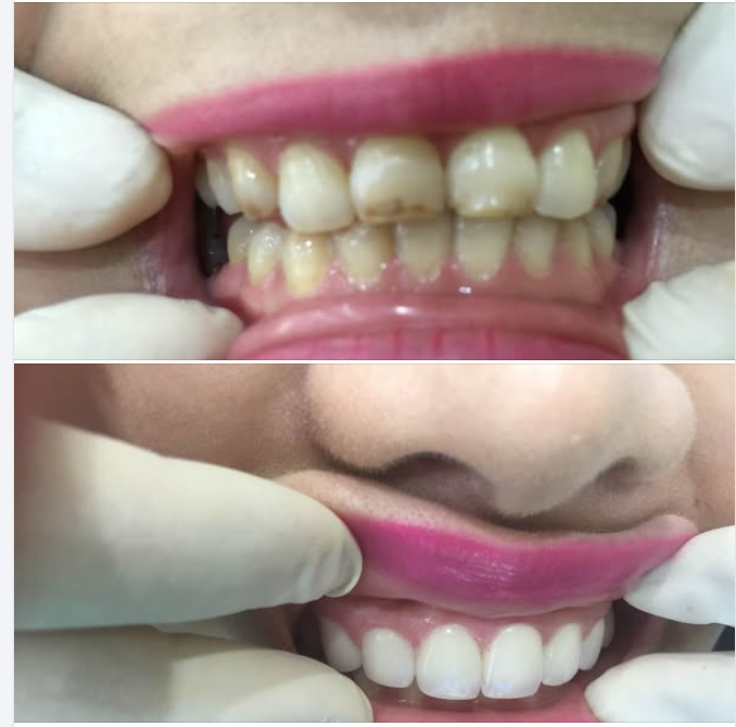 Bọc răng sứ giữ được bao lâu và hướng dẫn chăm sóc sau bọc răng