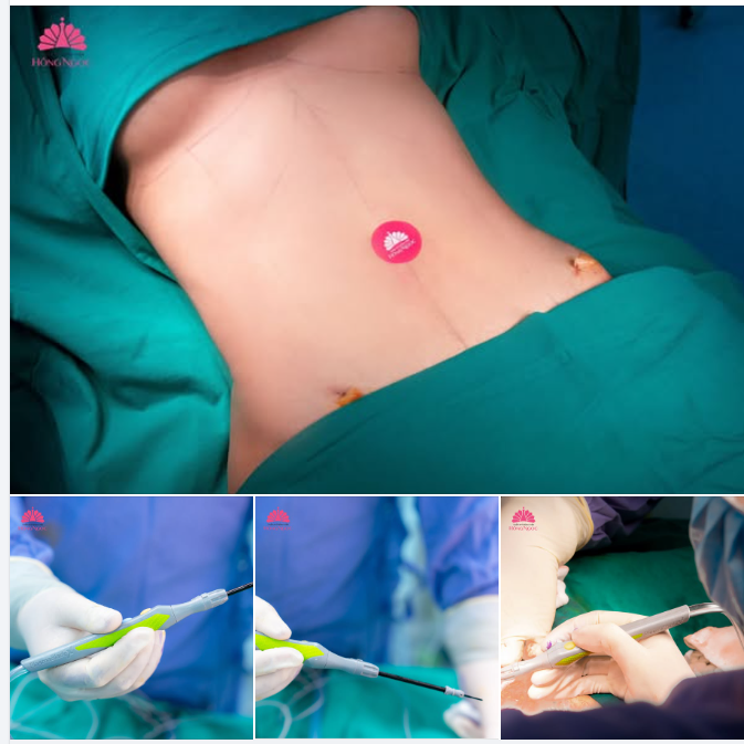 DAO MỔ PLASMA - “TRỢ THỦ VÀNG” TRONG PHẪU THUẬT NÂNG NGỰC