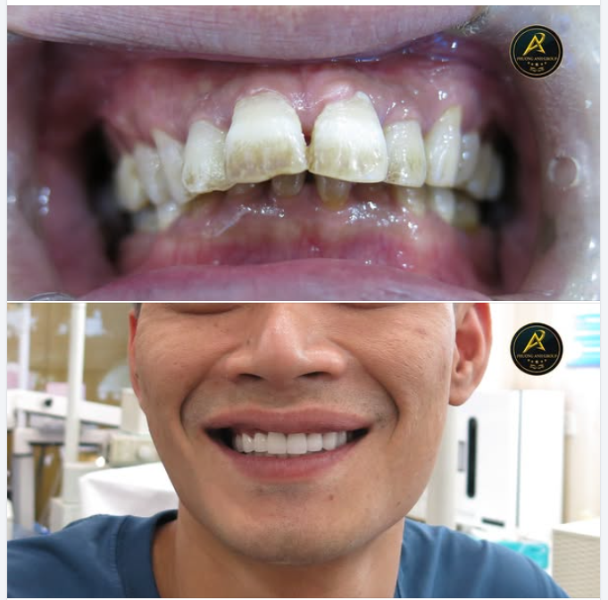 Thay đổi nụ cười sau bọc răng sứ