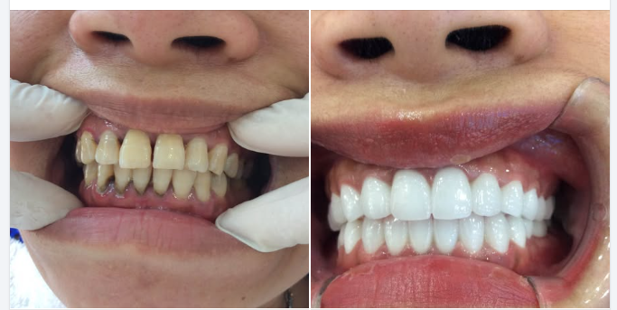 Làm cầu răng sứ có gây hôi miệng không ?