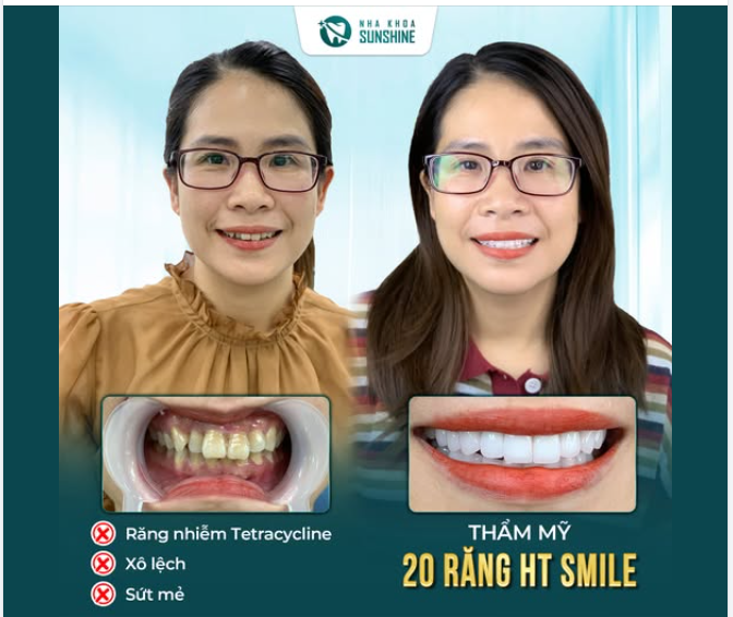“Mỗi lần nhìn vào gương thấy tự ti vì nụ cười…” ​​​​​​​ Không ít lần định đi làm răng, nhưng sợ “răng sứ nhìn giả”, nên cứ lần lữa mãi… cho đến khi chị biết đến Sunshine