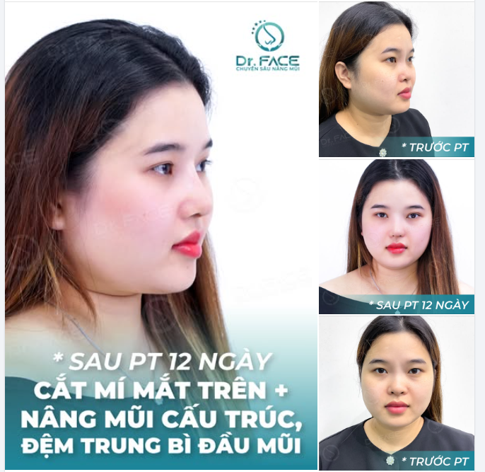 NÓI MŨI NÀY TỪNG NÂNG MÀ KHÔNG AI TIN