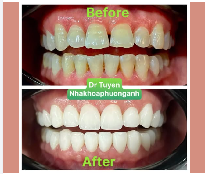 Bọc răng sứ thẩm mỹ là gì? có tốt không? có đau không?