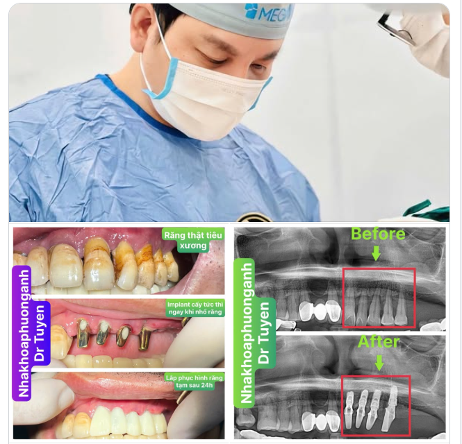 IMPLANT ONE TIME LÀ GÌ?