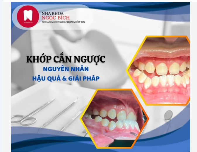 Khớp Cắn Ngược – Nguyên Nhân, Hậu Quả  Giải Pháp