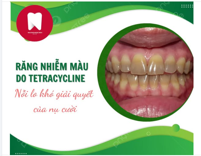 RĂNG NHIỄM MÀU TETRACYCLINE – NỖI LO KHÓ GIẢI QUYẾT CỦA NỤ CƯỜI