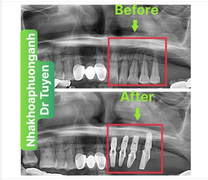 Hướng dẫn chăm sóc răng sau cấy implant