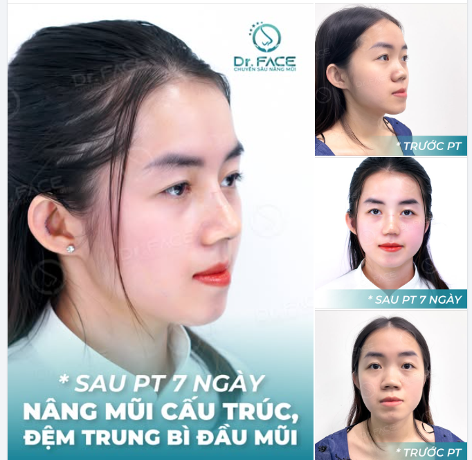 THANH XUÂN RỰC RỠ cùng dáng mũi mới tại DR.FACE