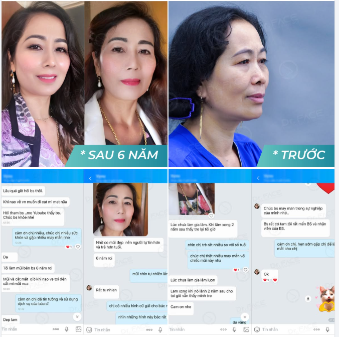 “6 NĂM RỒI, MŨI VẪN ĐẸP VÀ TỰ NHIÊN NHƯ NGÀY ĐẦU”