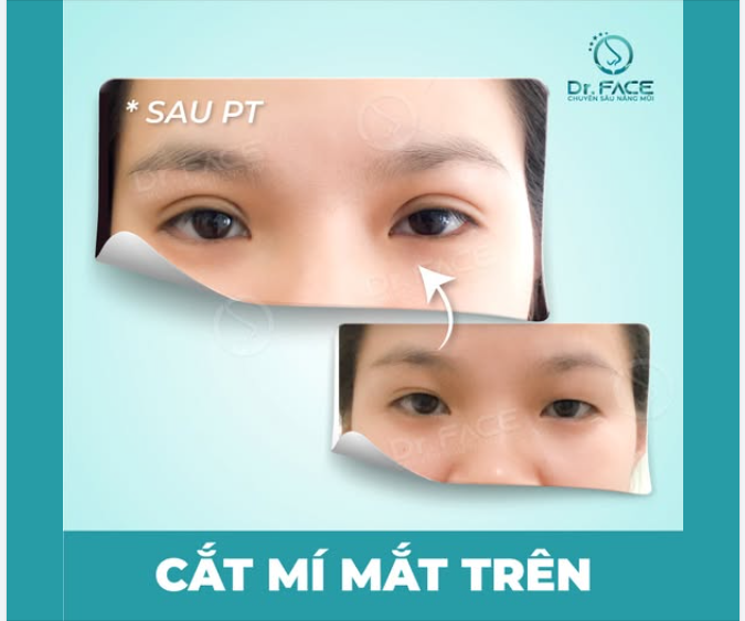 Tin được không, đây là đôi mắt CẮT MÍ được 14 NGÀY…