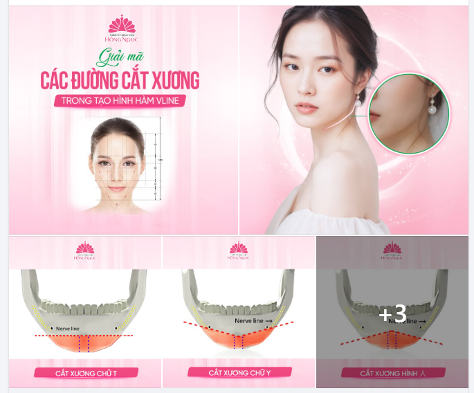 GIẢI MÃ CÁC ĐƯỜNG CẮT XƯƠNG TRONG PHẪU THUẬT TẠO HÌNH HÀM VLINE