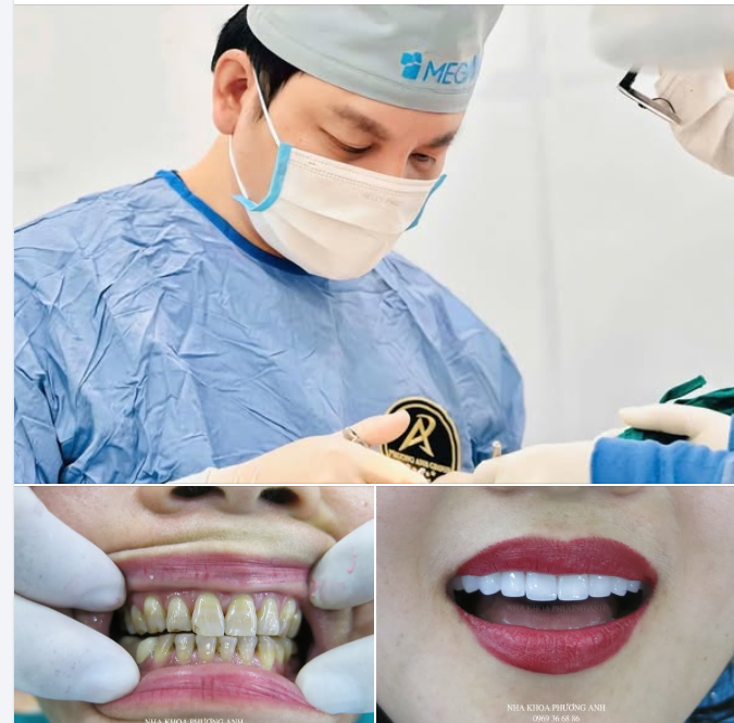 Cách Chọn Màu Răng Sứ Tự Nhiên Nhất?