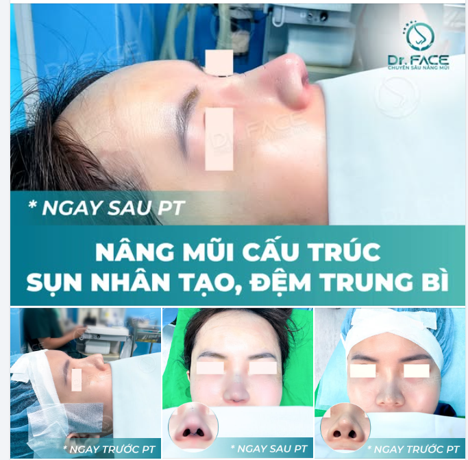 “BS ƠI, ĐẦU MŨI EM NÓ LẠ LẮM…”  Đó là lời tâm sự của bạn khi tìm đến DR.FACE.