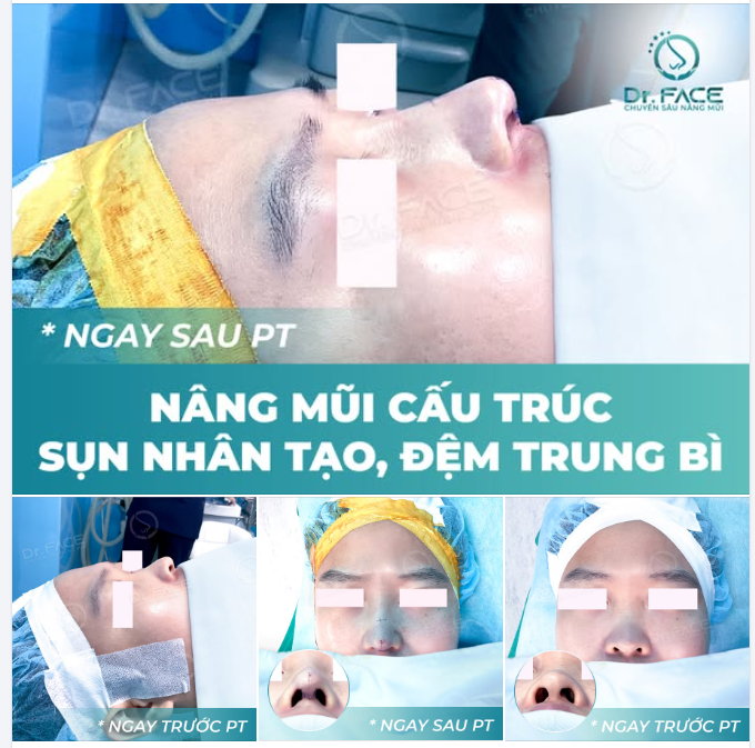 MŨI ĐẸP CHUẨN MEN – lựa chọn của nam giới hiện đại