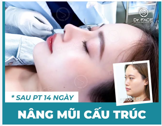 14 ngày sau phẫu thuật NÂNG MŨI CẤU TRÚC – chỉ cần nằm yên, để đường nét tự kể câu chuyện của mình.BS chỉ muốn nói: tự nhiên vẫn luôn là đích đến đẹp nhất.