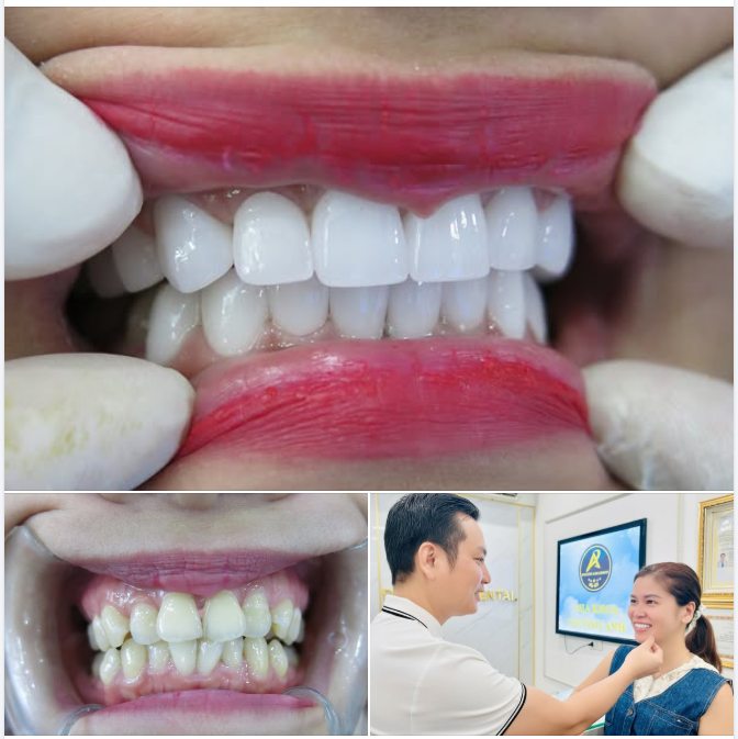 Màu răng Gradient tự nhiên