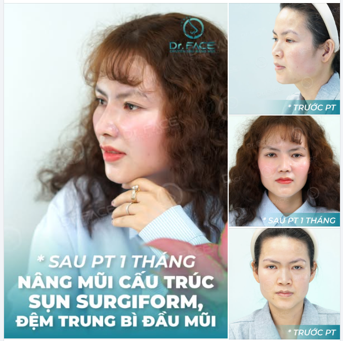 Định tới NHẬT, HÀN nâng mũi, cuối cùng CHỌN DR.FACE