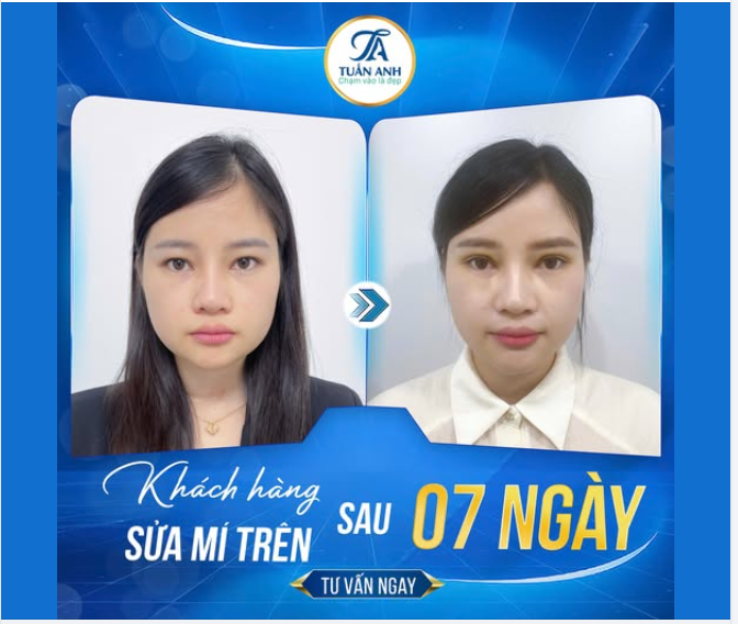 TẠM BIỆT MÍ SỤP CHỈ SAU 07 NGÀY