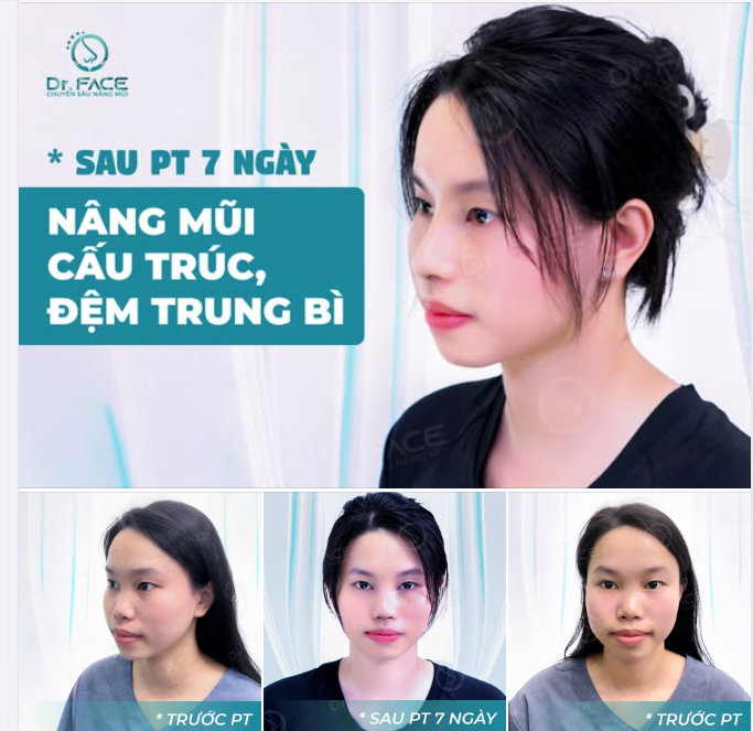 Nâng mũi cho dáng thêm xinh,  Tự tin tỏa sáng, lung linh mỗi ngày.