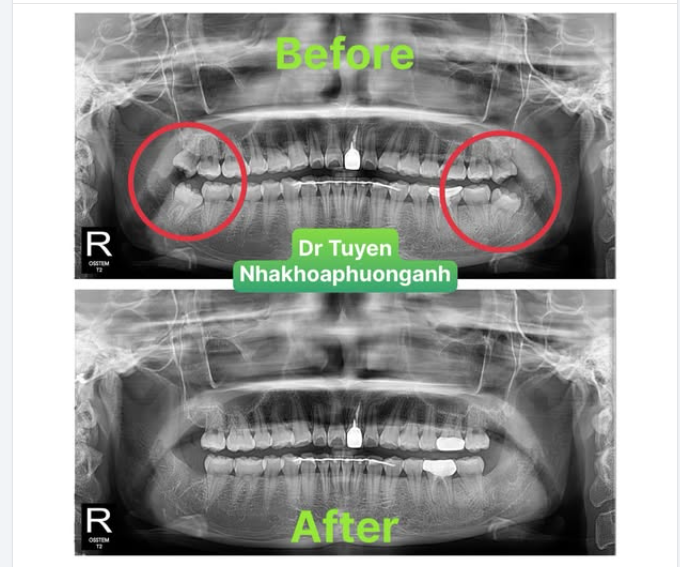 Trước khi nhổ răng khôn bạn cần làm gì