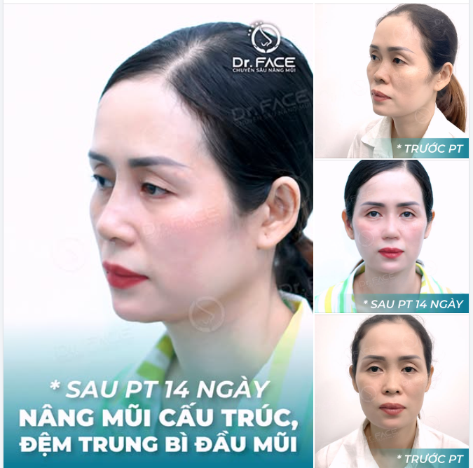 “THÍCH NHẤT ĐẦU MŨI TRÒN MỀM BS LÀM”