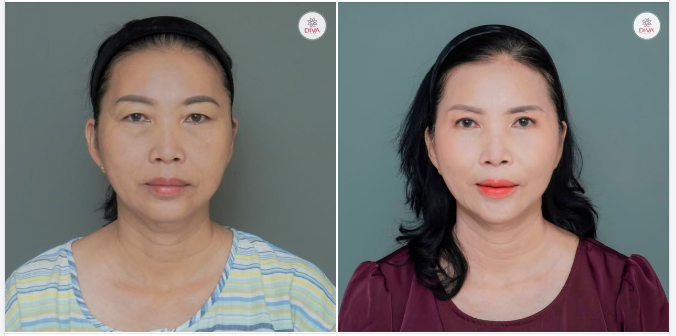 CẢI THIỆN KHUYẾT ĐIỂM ĐÔI MẮT - THAY ĐỔI CẢ THẦN THÁI KHUÔN MẶT!