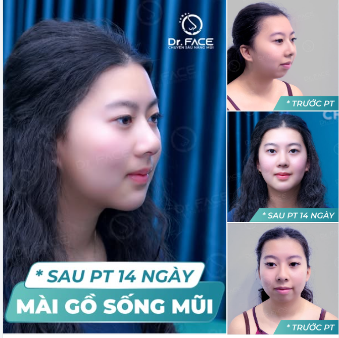 Chỉ MÀI GỒ sống mũi – MẶT DỊU LIỀN một cách bất ngờ