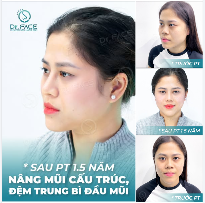 Mũi cao mà vẫn dịu hiền,  Tự nhiên, mềm mại, lâu bền thời gian.