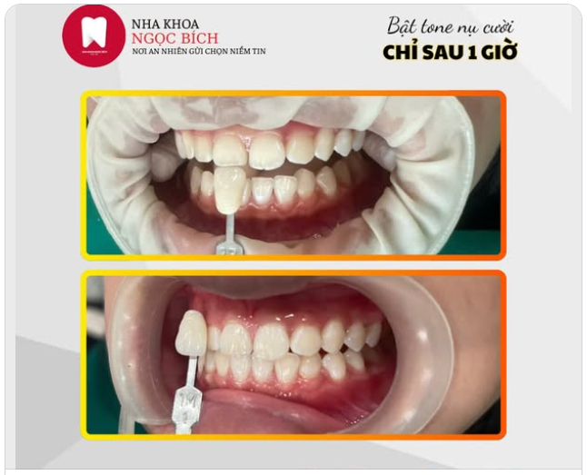 TỰ TIN TỎA SÁNG VỚI NỤ CƯỜI TRẮNG SÁNG