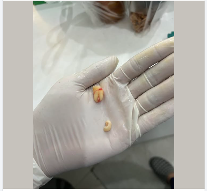 Một chiếc răng 8 bé xinh, mỗi tội hơi lệch nên bác sĩ phải cắt một góc. Trộm vía là nhổ nhẹ nhàng, khoảng 5p là xong rồi, không đau gì đâu cả nhà nhé!